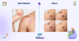 difference between birthmark and mole
